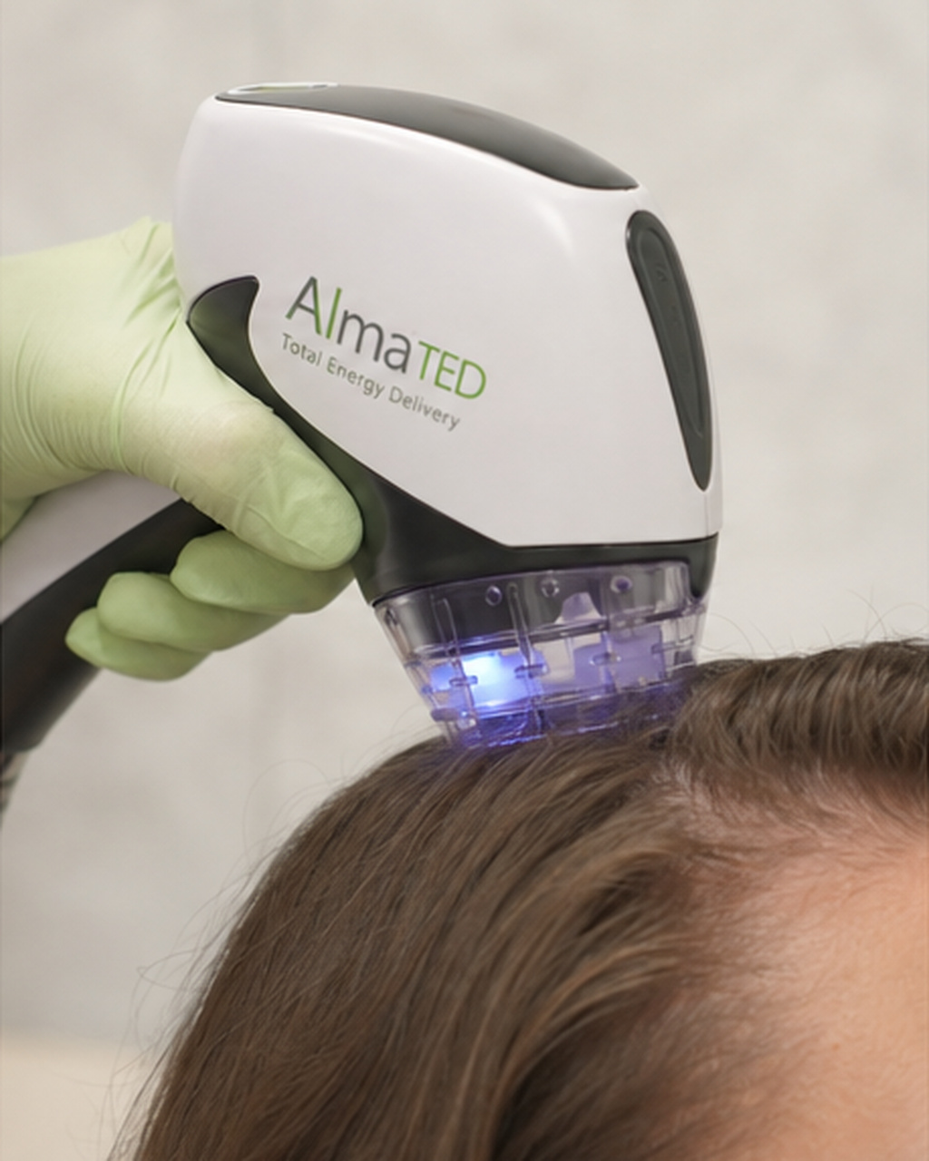 A gloved clinician holds the Alma TED handpiece against a patient's scalp during treatment